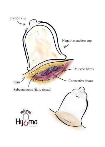 Hijama Diagram