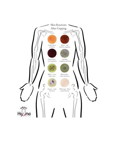 Hijama Skin Reactions