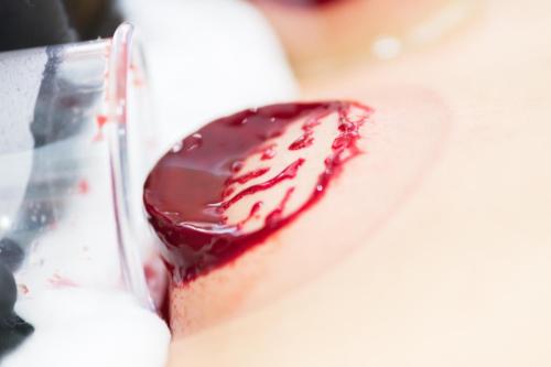 Hijama Treatment