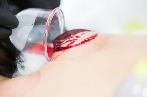 Hijama Treatment