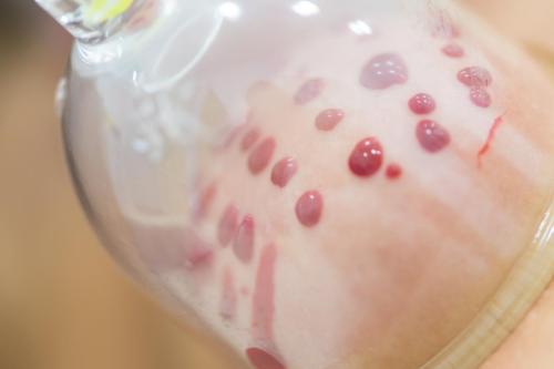 Hijama Treatment