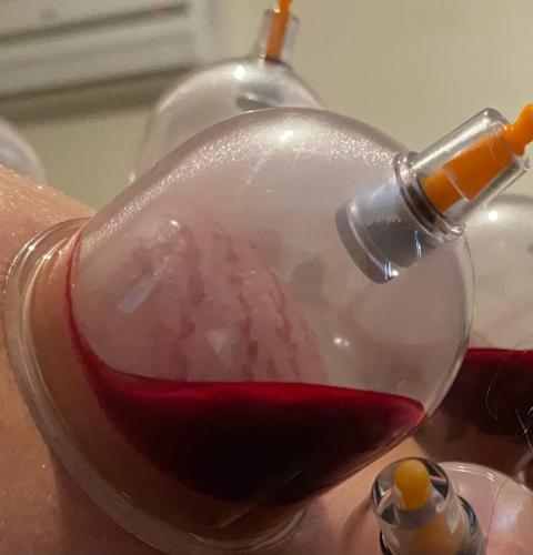 Hijama Treatment