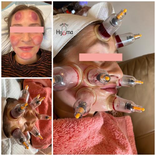 Hijama Face Treatment