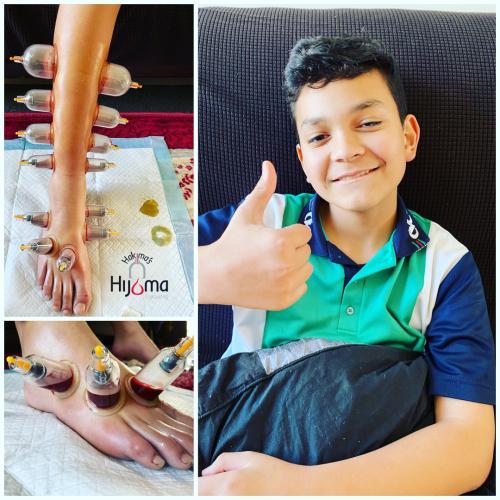 Hijama Child Treatment