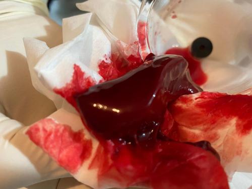 Hijama Treatment Clotting