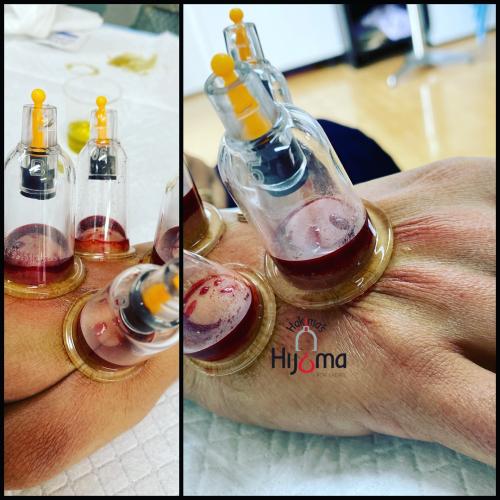 Hijama Hand Treatment