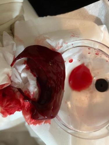 Hijama Treatment Clotting