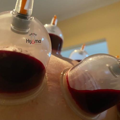 Hijama Treatment