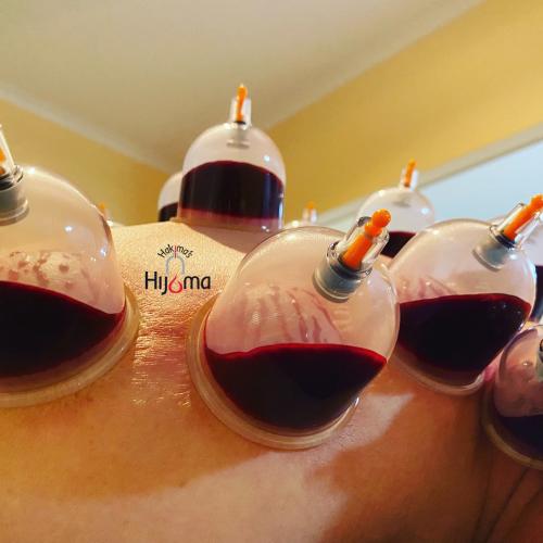 Hijama Treatment