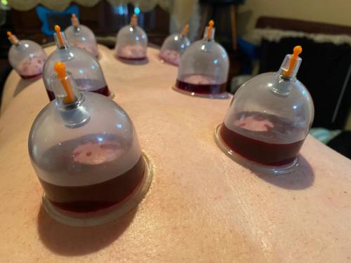 Hijama Back Treatment