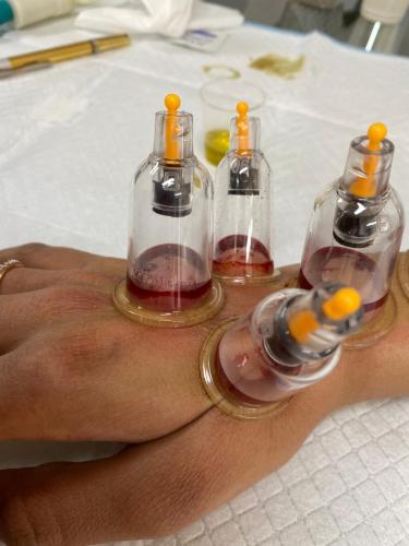 Hijama Hand Treatment