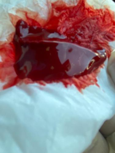 Hijama Treatment Clotting