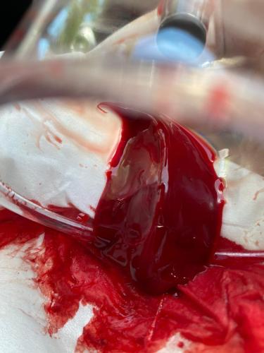 Hijama Treatment Clotting