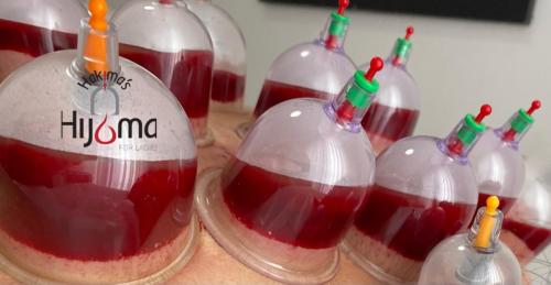 Hijama Wet Cupping