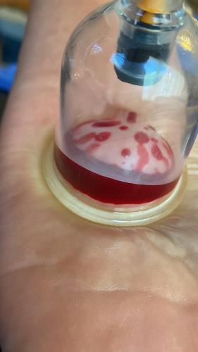 Hijama Treatment Suction Cup