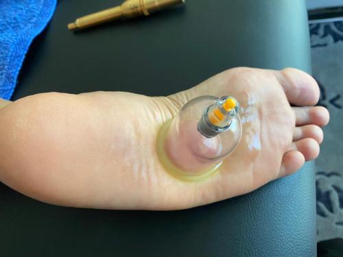 Hijama Foot Treatment