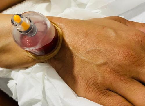 Hijama Hand Treatment
