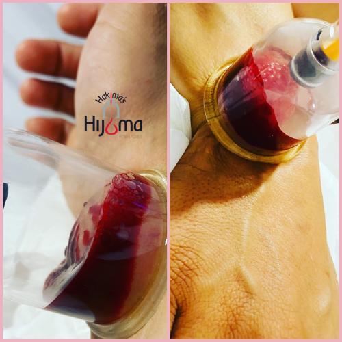 Hijama Hand Treatment