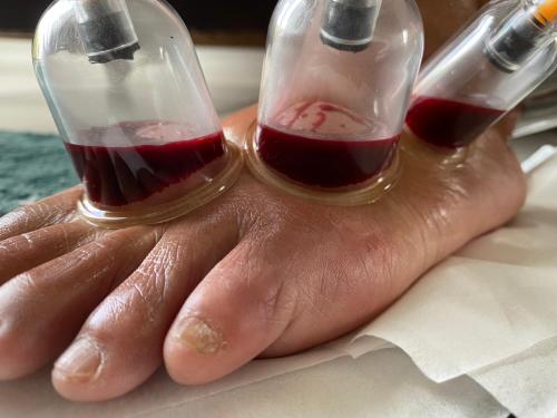 Hijama Foot Treatment