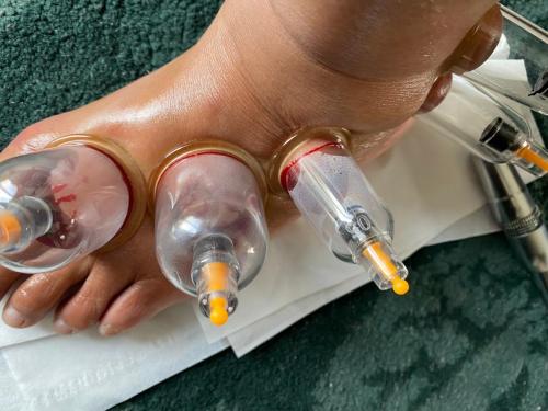 Hijama Treatment Foot