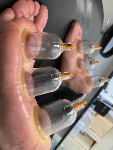Female Hijama & Wet Cupping Perth
