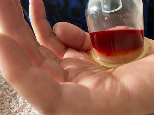 Female Hijama & Wet Cupping Perth