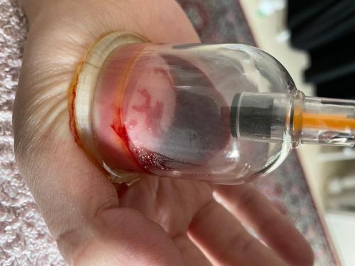 Female Hijama & Wet Cupping Perth