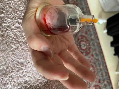 Female Hijama & Wet Cupping Perth
