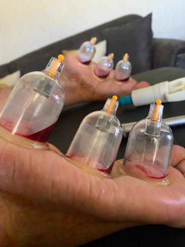 Female Hijama & Wet Cupping Perth