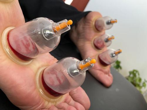 Female Hijama & Wet Cupping Perth