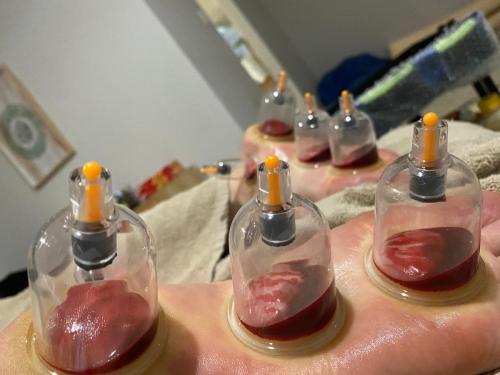 Female Hijama & Wet Cupping Perth