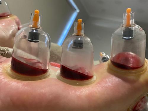 Female Hijama & Wet Cupping Perth
