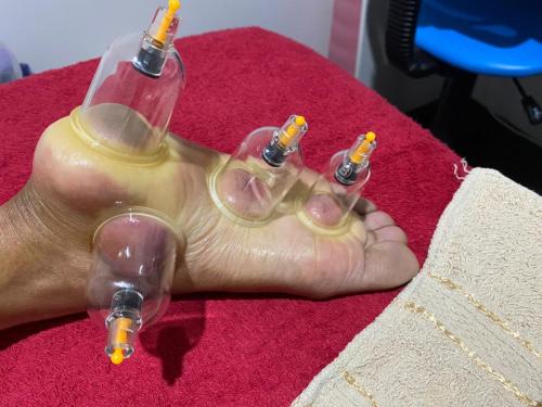 Female Hijama & Wet Cupping Perth