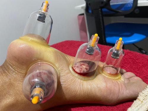 Female Hijama & Wet Cupping Perth