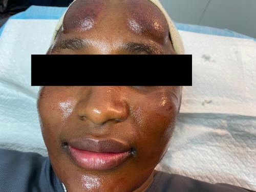 Female Hijama & Wet Cupping Perth