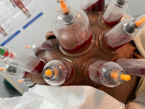 Female Hijama & Wet Cupping Perth
