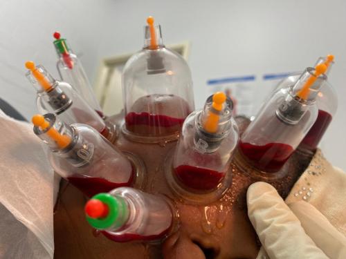 Female Hijama & Wet Cupping Perth