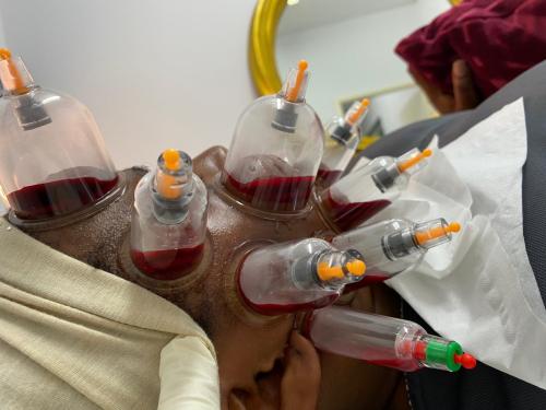 Female Hijama & Wet Cupping Perth