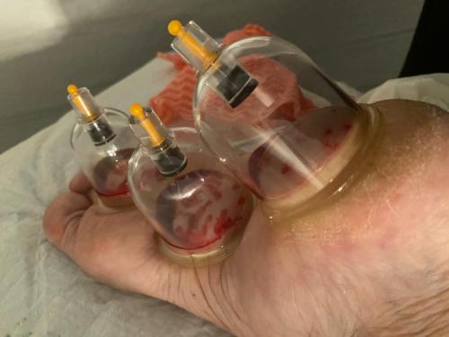 Female Hijama & Wet Cupping Perth