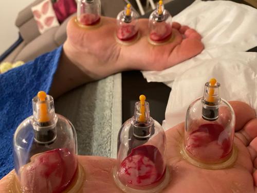 Female Hijama & Wet Cupping Perth