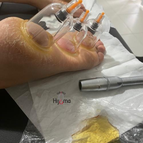 Hijama Patient Foot