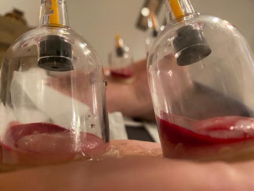 Female Hijama & Wet Cupping Perth